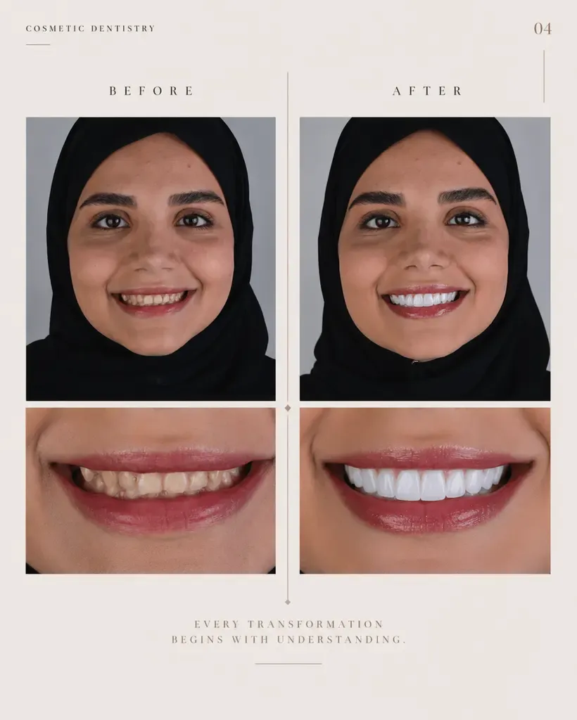 قبل و بعد طراحی لبخند — نمونهکار دندانپزشکی دماوند